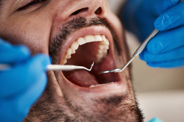 Best Broken or Cracked Tooth Emergency Dentist in Aromas, CA